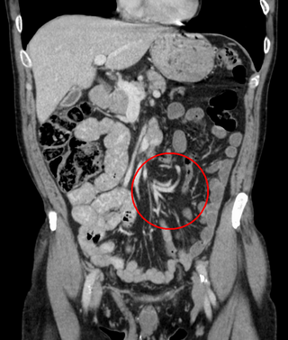 <span class="mw-page-title-main">Volvulus</span> Twisting of part of the intestine, causing a bowel obstruction