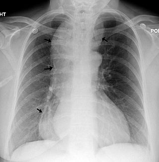 <span class="mw-page-title-main">Esophageal achalasia</span> Rare, incurable, progressive motility disorder due to failure of esophogeal motor neurons