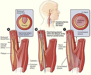 <span class="mw-page-title-main">Carotid stenting</span>