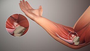 Golfers-Elbow Golfers-Elbow SAG.jpg