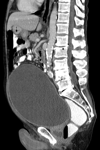 <span class="mw-page-title-main">Urinary retention</span> Inability to completely empty the bladder