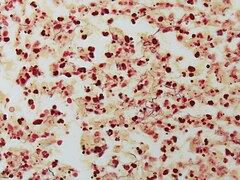 Nocardiosis - Gram stain Case 149 (5286067518).jpg