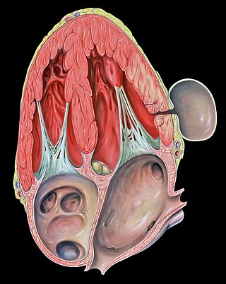 <span class="mw-page-title-main">Pseudoaneurysm</span> Collection of blood between outer artery layers