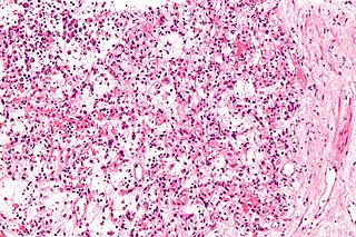 <span class="mw-page-title-main">Inflammatory myofibroblastic tumour</span> Medical condition