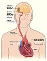 V levé srdeční předsíni se postupně vytváří krevní sraženina (díky turbulencím krve). Část byla vymrštěna do mozku. Za ucpanou cévou začínají odumírat mozkové buňky. Projevilo se ochrnutí půli těla.