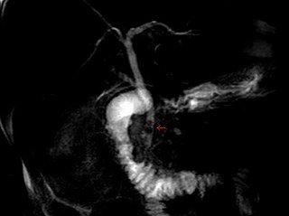 <span class="mw-page-title-main">Common bile duct stone</span> Medical condition