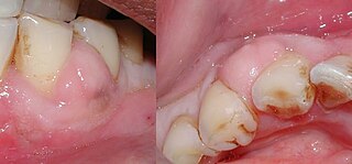 <span class="mw-page-title-main">Periodontal abscess</span> Medical condition