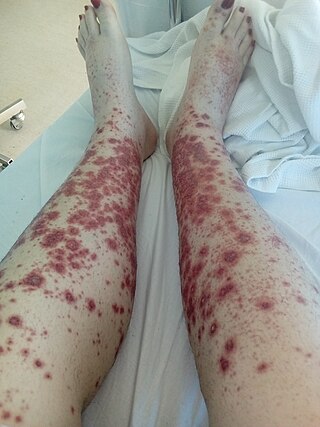 <span class="mw-page-title-main">Systemic vasculitis</span> Medical condition