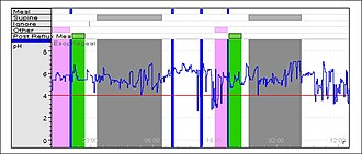 96 Hour Bravo pH monitoring A sample of Bravo pH tracing recorded over 48 hours Bravo tracing.jpg