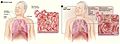 慢性閉塞性肺疾患(COPD)、肺気腫のイラスト