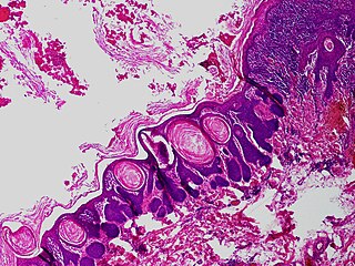 Trichofolliculoma