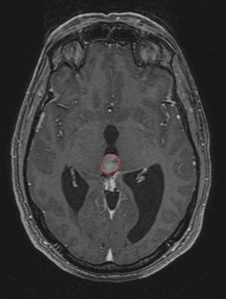 <span class="mw-page-title-main">Pinealoma</span> Medical condition