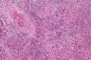 Granulomatosis with polyangiitis Medical condition