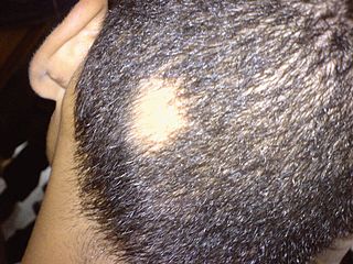 <span class="mw-page-title-main">Alopecia areata</span> Condition in which hair is lost from some or all areas of the body