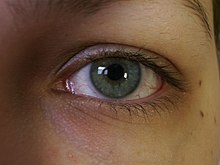 Red eyes can be treated with naphazoline. Bloodshot eye.jpg