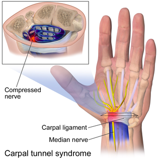 <span class="mw-page-title-main">Carpal tunnel surgery</span>