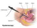 Thumbnail for Hysteroscopy