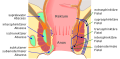 Grafische Darstellung der unterschiedlichen Analabszess- (links) und Analfisteltypen (rechts)