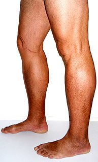 Chronic venous insufficiency Medical condition