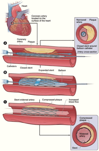 <span class="mw-page-title-main">Restenosis</span> Recurrence of stenosis, a narrowing of a blood vessel