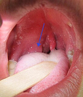 Peritonsillar abscess Pus behind the tonsil due to an infection