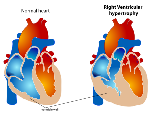 <span class="mw-page-title-main">Ventricular hypertrophy</span> Medical condition