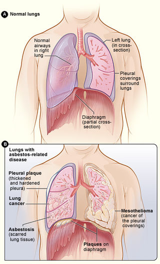 <span class="mw-page-title-main">Asbestos-related diseases</span> Disorders of the lung and pleura caused by the inhalation of asbestos fibres