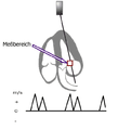 Schema der Messung mittels PW-Doppler an der Mitralklappe