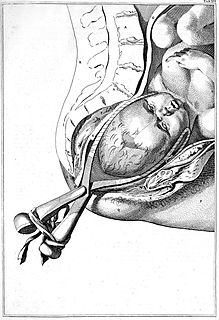 Obstetrical forceps