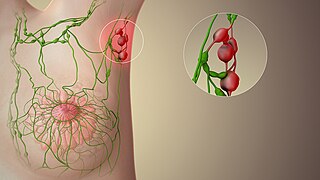 <span class="mw-page-title-main">Sentinel lymph node</span> First lymph node to receive drainage from a primary tumor