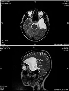 <span class="mw-page-title-main">Arachnoid cyst</span> Medical condition