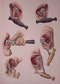 illustration demonstrating the use of the dental key for extracting teeth. Dentalkeyusage.jpg