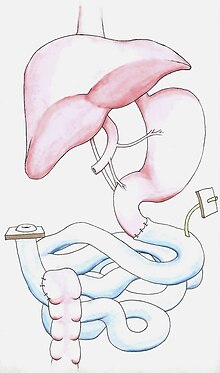 Isolated intestine transplant diagram. Intestine Transplant Diagram.jpg