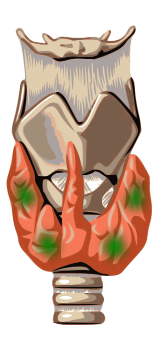 <span class="mw-page-title-main">Parathyroid carcinoma</span> Medical condition