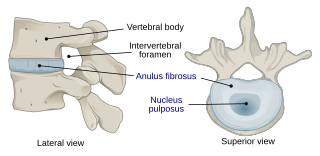 <span class="mw-page-title-main">Intervertebral disc</span> Cartilage of spine