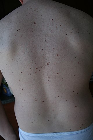 <span class="mw-page-title-main">Dysplastic nevus syndrome</span> Medical condition