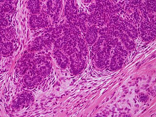 Trichoblastoma