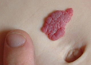 Infantile hemangioma human disease