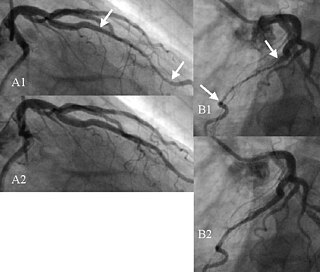 <span class="mw-page-title-main">Myocardial bridge</span> Birth defect of a coronary artery through the heart muscle