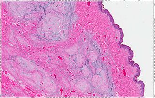 <span class="mw-page-title-main">Cutaneous myxoma</span>