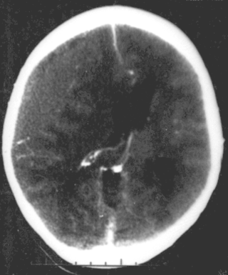 <span class="mw-page-title-main">Focal and diffuse brain injury</span> Medical condition