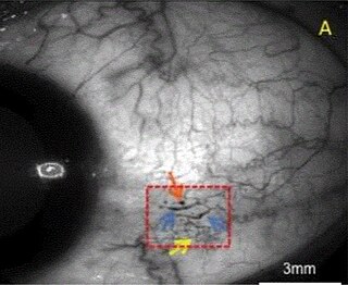 <span class="mw-page-title-main">Microangiopathy</span> Medical condition