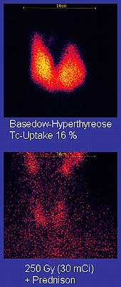 Gambar atas: dua fitur mirip tetesan air bergabung di bagian bawahnya; mereka memiliki pusat kuning dan tepi merah dengan latar belakang hitam. Keterangan: Graves' Disease Tc-Uptake 16%. Gambar bawah: titik merah pada latar belakang hitam. Keterangan: 250 Gy (30mCi) + Prednison.