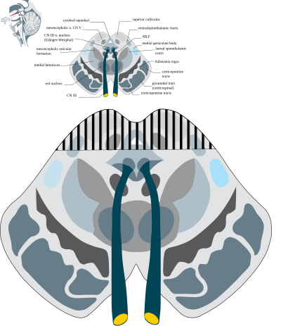 Cross section of midbrain. The area affected in Parinaud's syndrome is indicated by the striped region. Parinaud's syndrome.svg