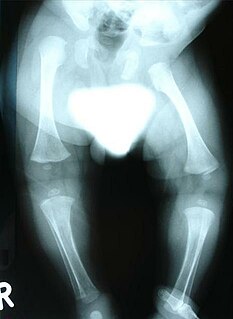 Congenital distal spinal muscular atrophy Hereditary condition characterized by muscle wasting