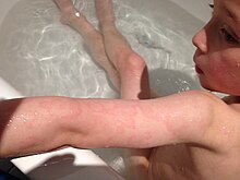 Erythema marginatum Erythema marginatum.jpg