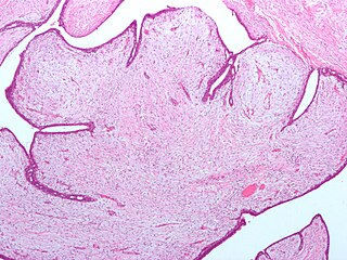 <span class="mw-page-title-main">Fibroepithelial neoplasm</span> Medical condition