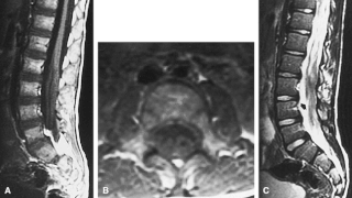 <span class="mw-page-title-main">Dejerine–Sottas disease</span> Medical condition