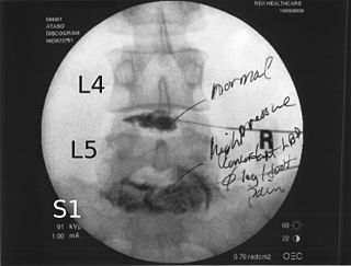 <span class="mw-page-title-main">Lumbar provocative discography</span>