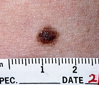 <span class="mw-page-title-main">Nevus</span> Mole or birthmark; visible, circumscribed, chronic skin lesion